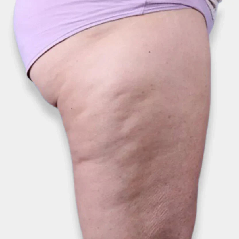 Wie bekämpft man Cellulite effektiv?