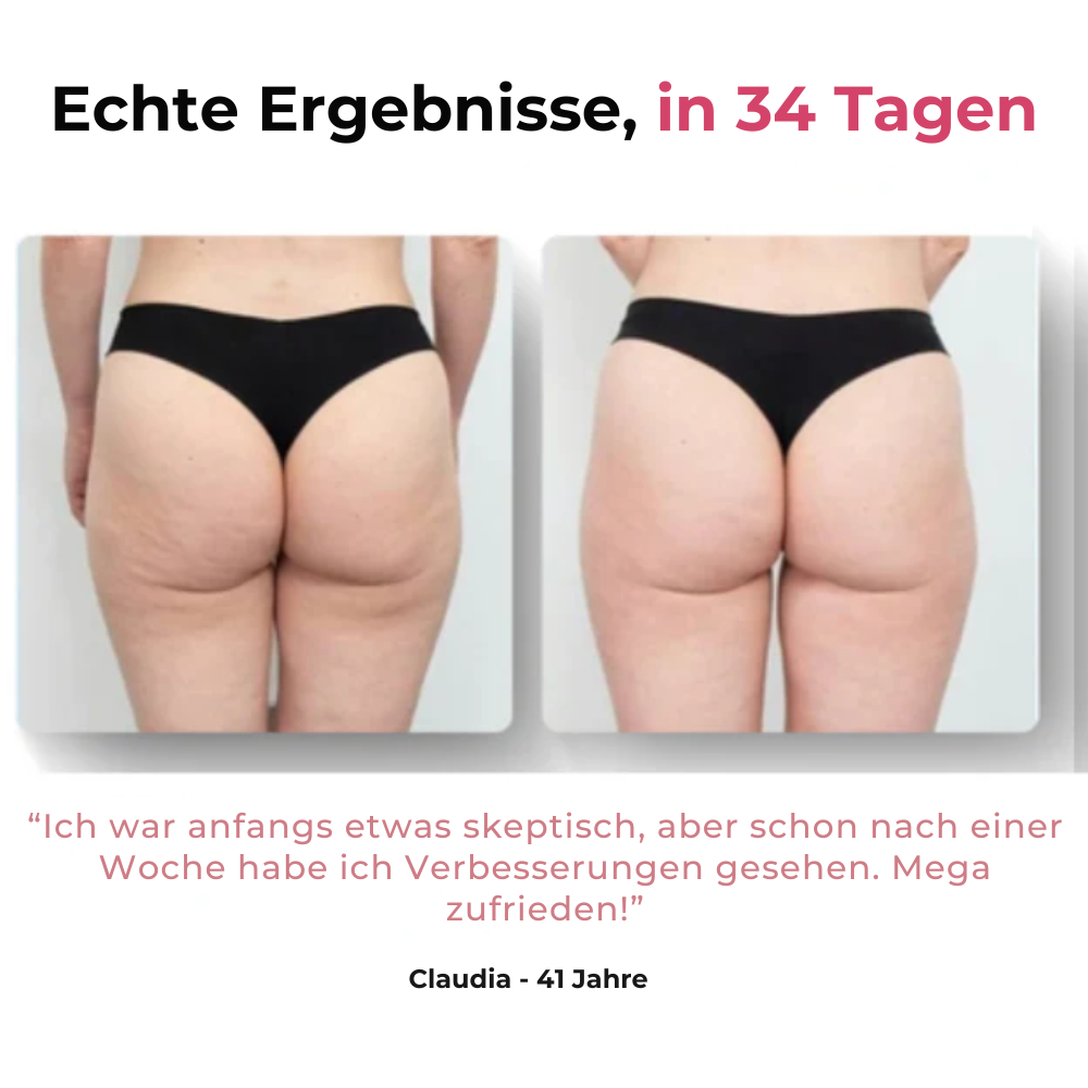 Skincys™ - Anti-Cellulite Massagegerät