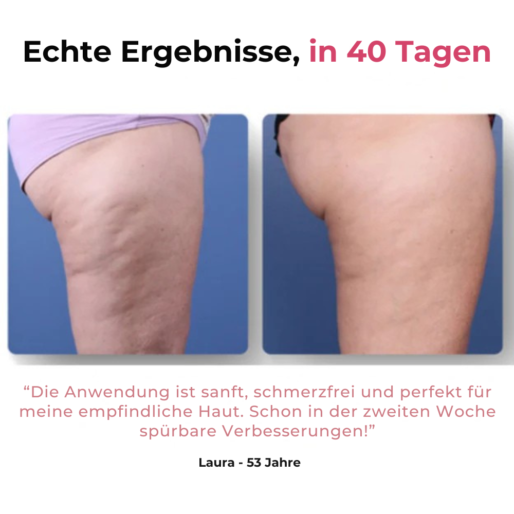 Skincys™ - Anti-Cellulite Massagegerät